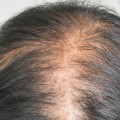 The Best Hair Loss Treatments in Ada County, Idaho